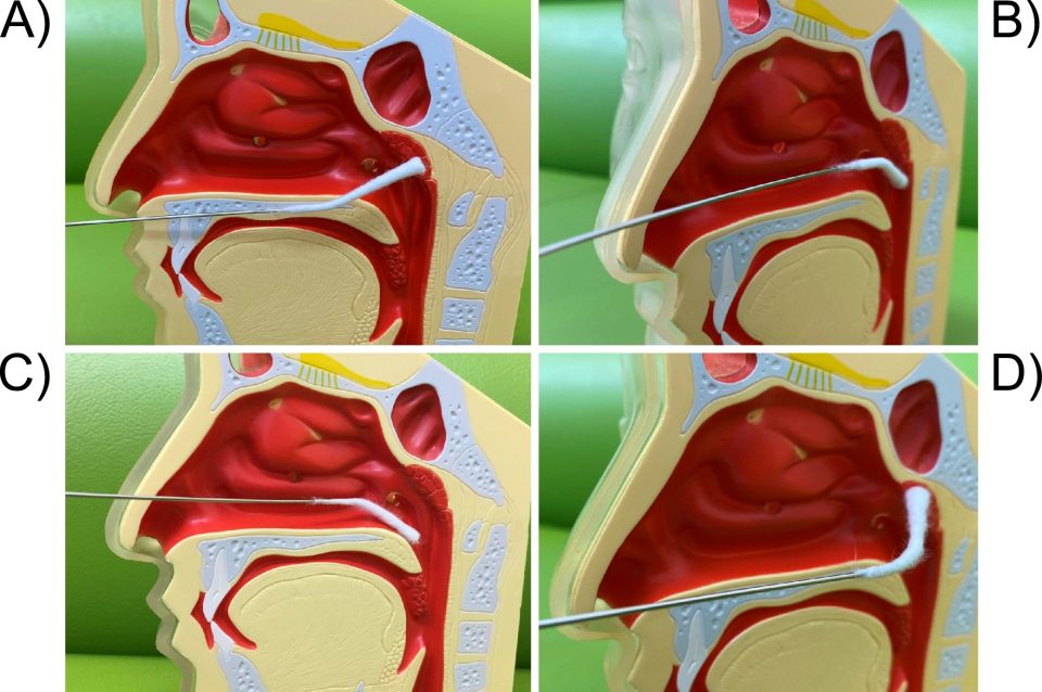 Model of Chronic Epipharyngitis Treated with Epipharyngeal Abrasion Therapy: Symptoms, Diagnosis, Pathogenesis, and Treatment Outcomes | JMA Journal